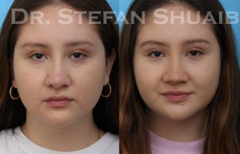 female patient before and after rhinoplasty