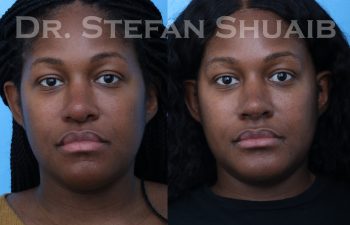 female patient before and after african american rhinoplasty procedure