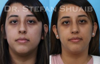 female patient before and after rhinoplasty