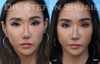 female patient before and after asian rhinoplasty procedure