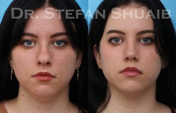 female patient before and after rhinoplasty