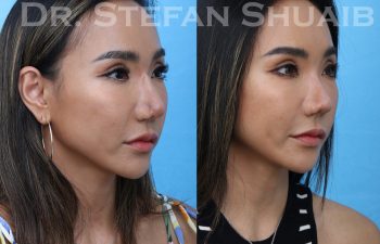 female patient before and after asian rhinoplasty procedure