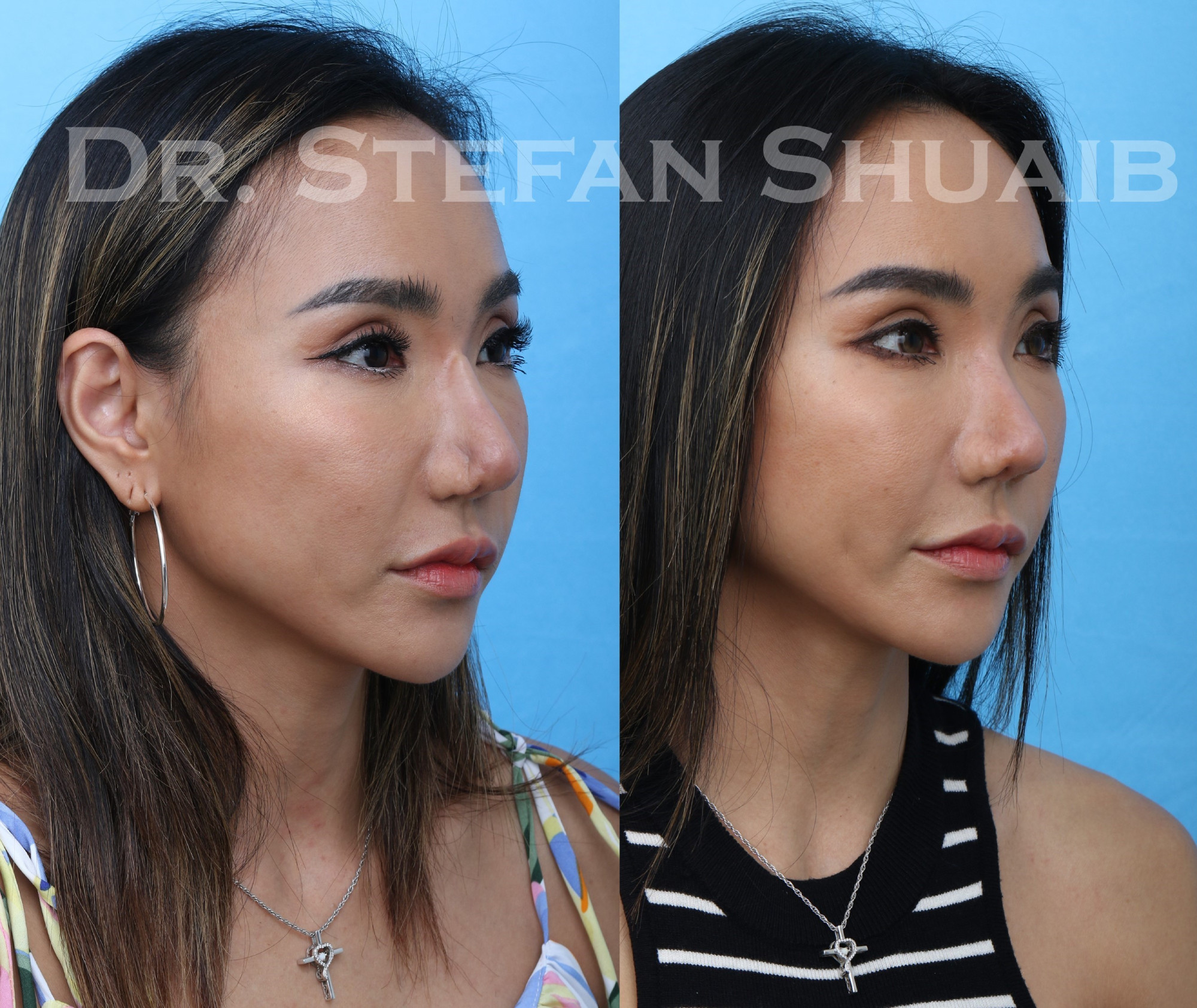 female patient before and after asian rhinoplasty procedure