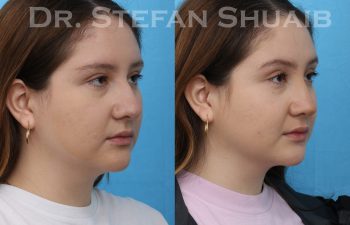 female patient before and after rhinoplasty