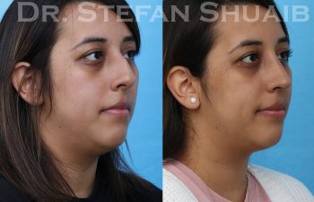 female patient before and after rhinoplasty