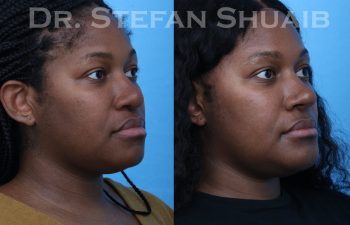 female patient before and after african american rhinoplasty procedure