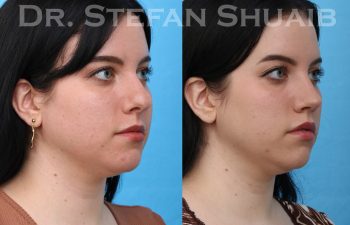 female patient before and after rhinoplasty