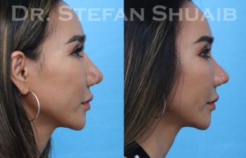 female patient before and after asian rhinoplasty procedure