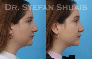 female patient before and after rhinoplasty