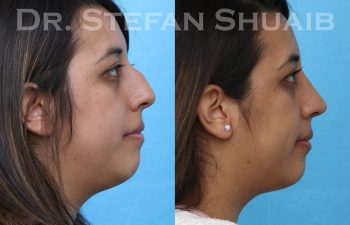 female patient before and after rhinoplasty