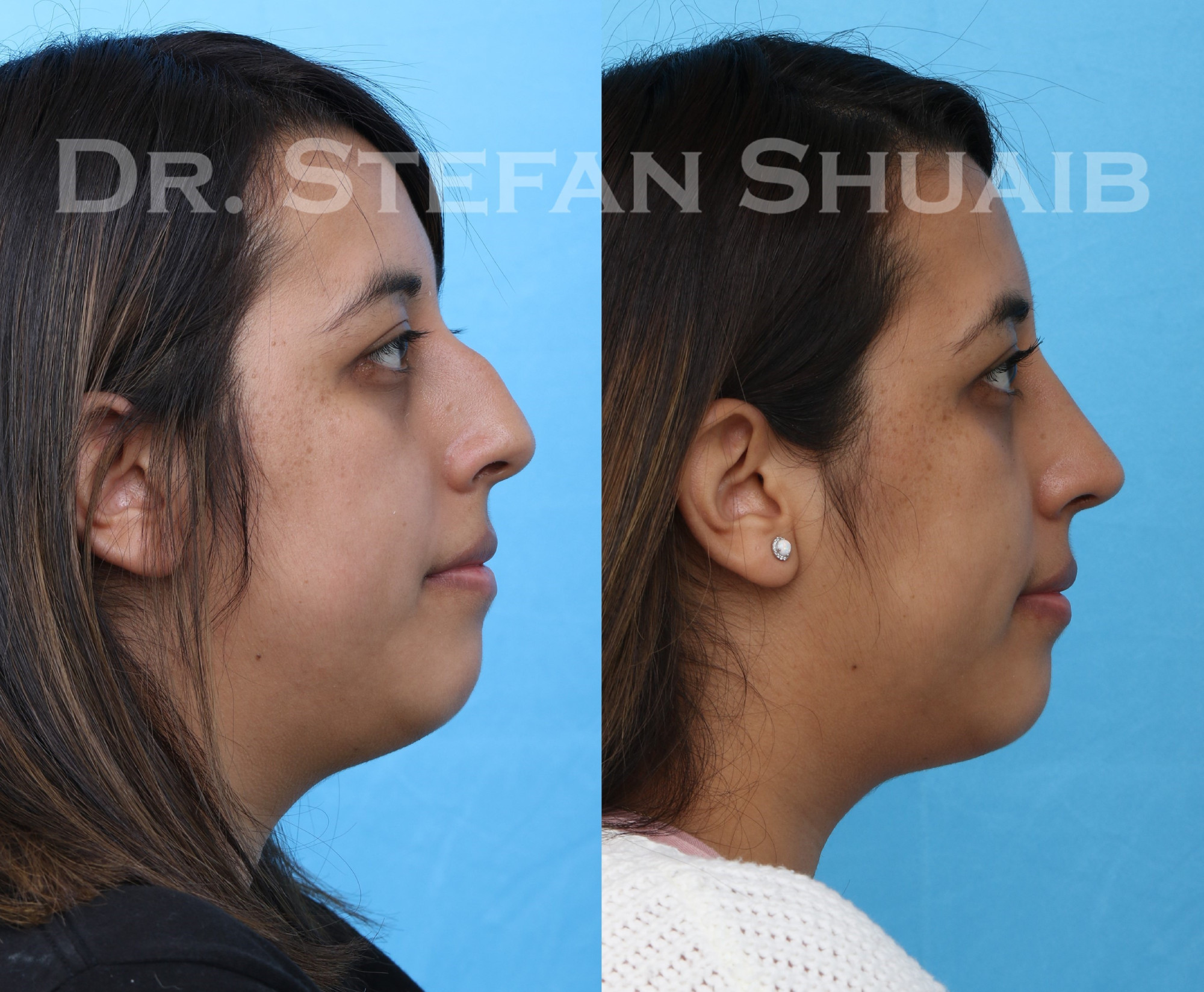 female patient before and after rhinoplasty