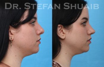 female patient before and after rhinoplasty