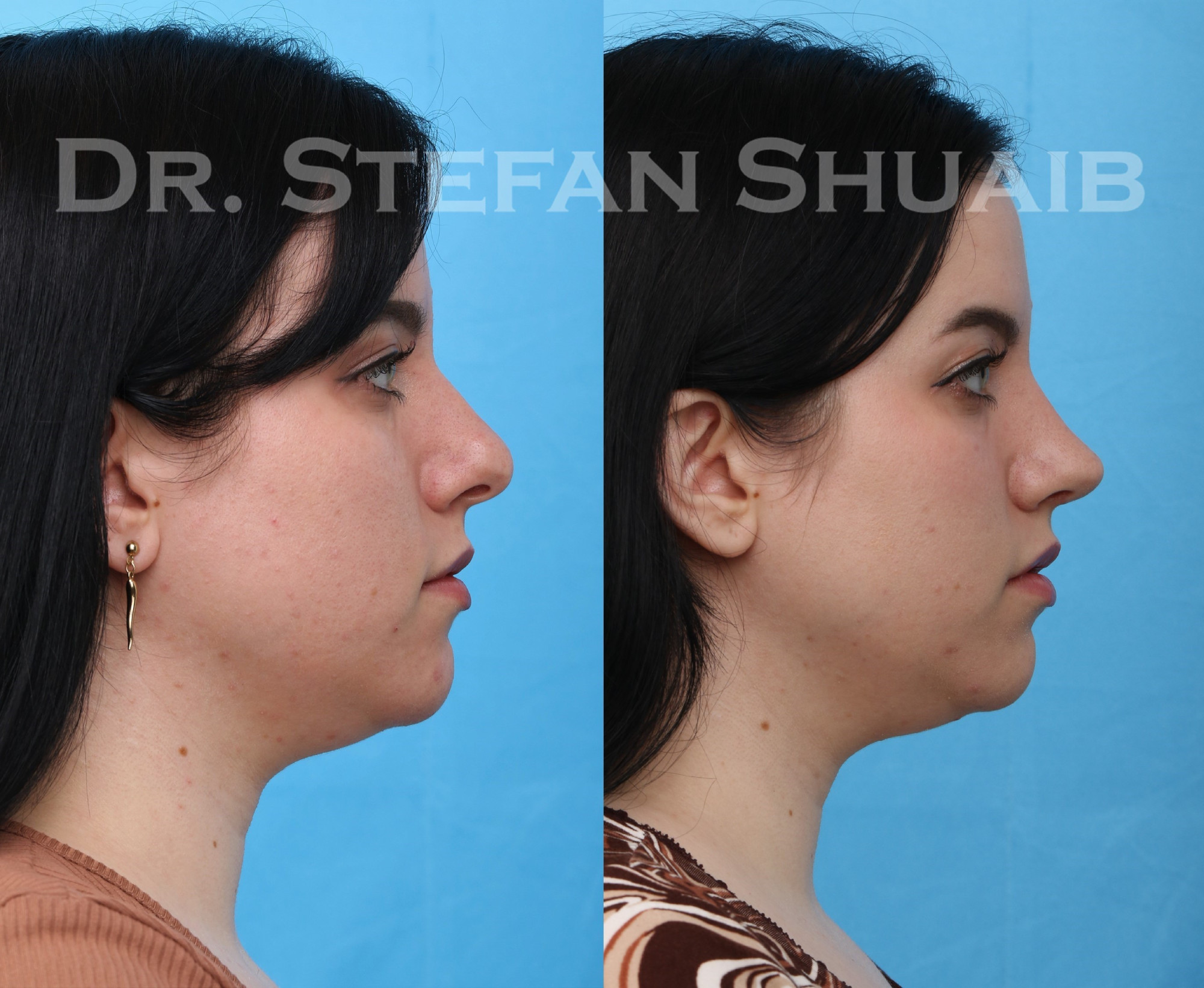 female patient before and after rhinoplasty