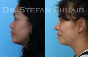 Patient before and after augmentation rhinoplasty as well as upper and lower blepharoplasty