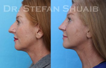 female patient before and after rhinoplasty procedure