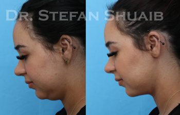 female patient before and after neck lift procedure