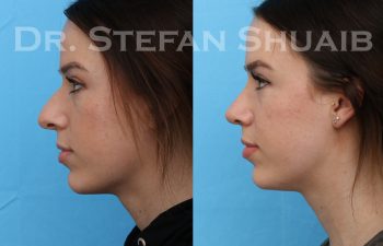 female patient before and after rhinoplasty procedure