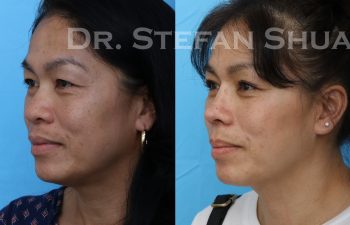 Patient before and after augmentation rhinoplasty as well as upper and lower blepharoplasty