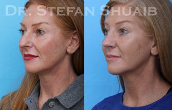 female patient before and after rhinoplasty procedure