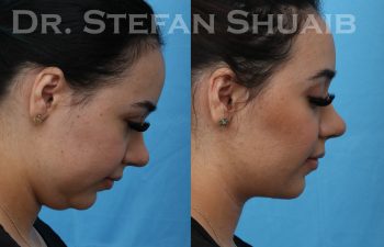 female patient before and after neck lift procedure
