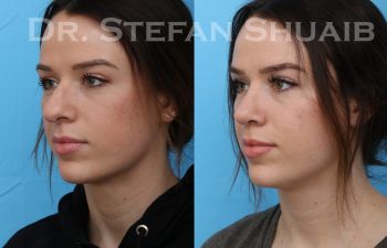 female patient before and after rhinoplasty procedure