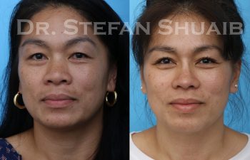 Patient before and after augmentation rhinoplasty as well as upper and lower blepharoplasty