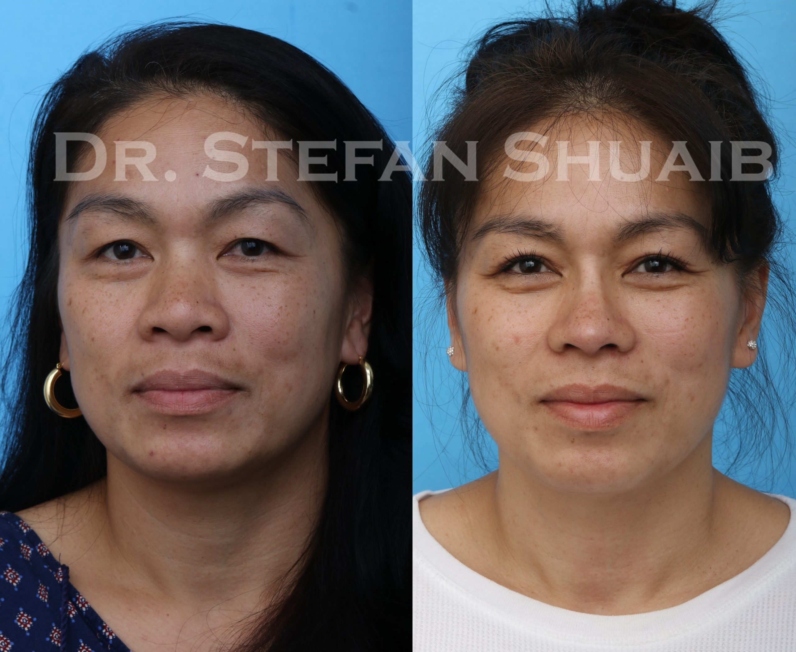 Patient before and after augmentation rhinoplasty as well as upper and lower blepharoplasty
