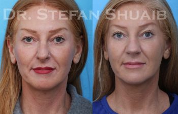 female patient before and after rhinoplasty procedure