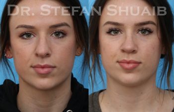 female patient before and after rhinoplasty procedure