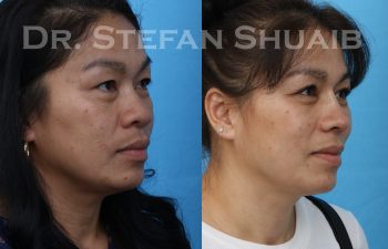 Patient before and after augmentation rhinoplasty as well as upper and lower blepharoplasty