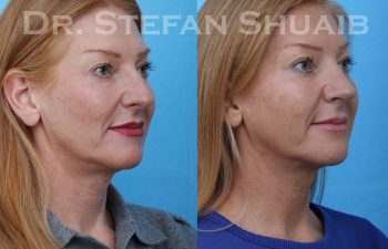 female patient before and after rhinoplasty procedure