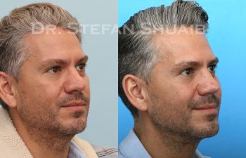 male patient before and after neck lift procedure