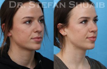 female patient before and after rhinoplasty procedure