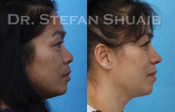 Patient before and after augmentation rhinoplasty as well as upper and lower blepharoplasty