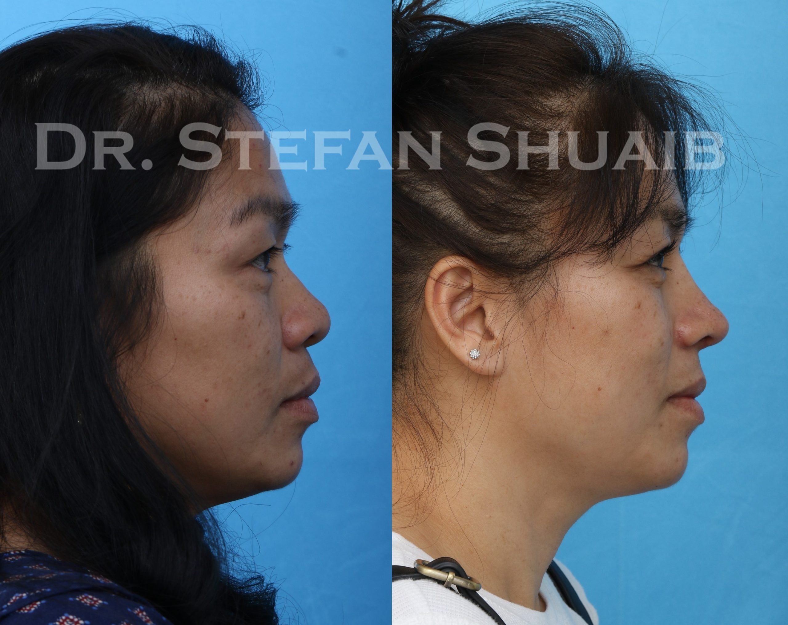 Patient before and after augmentation rhinoplasty as well as upper and lower blepharoplasty
