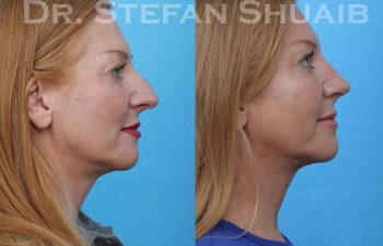 female patient before and after rhinoplasty procedure