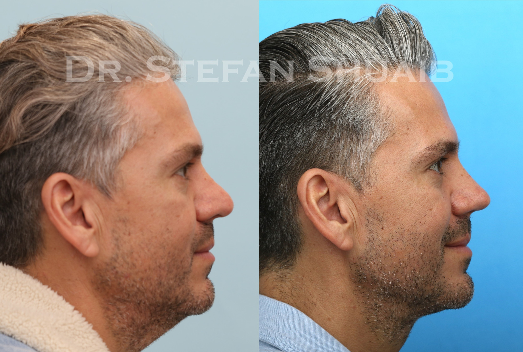 male patient before and after neck lift procedure
