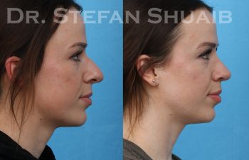 female patient before and after rhinoplasty procedure