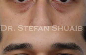 patient before and after blepharoplasty