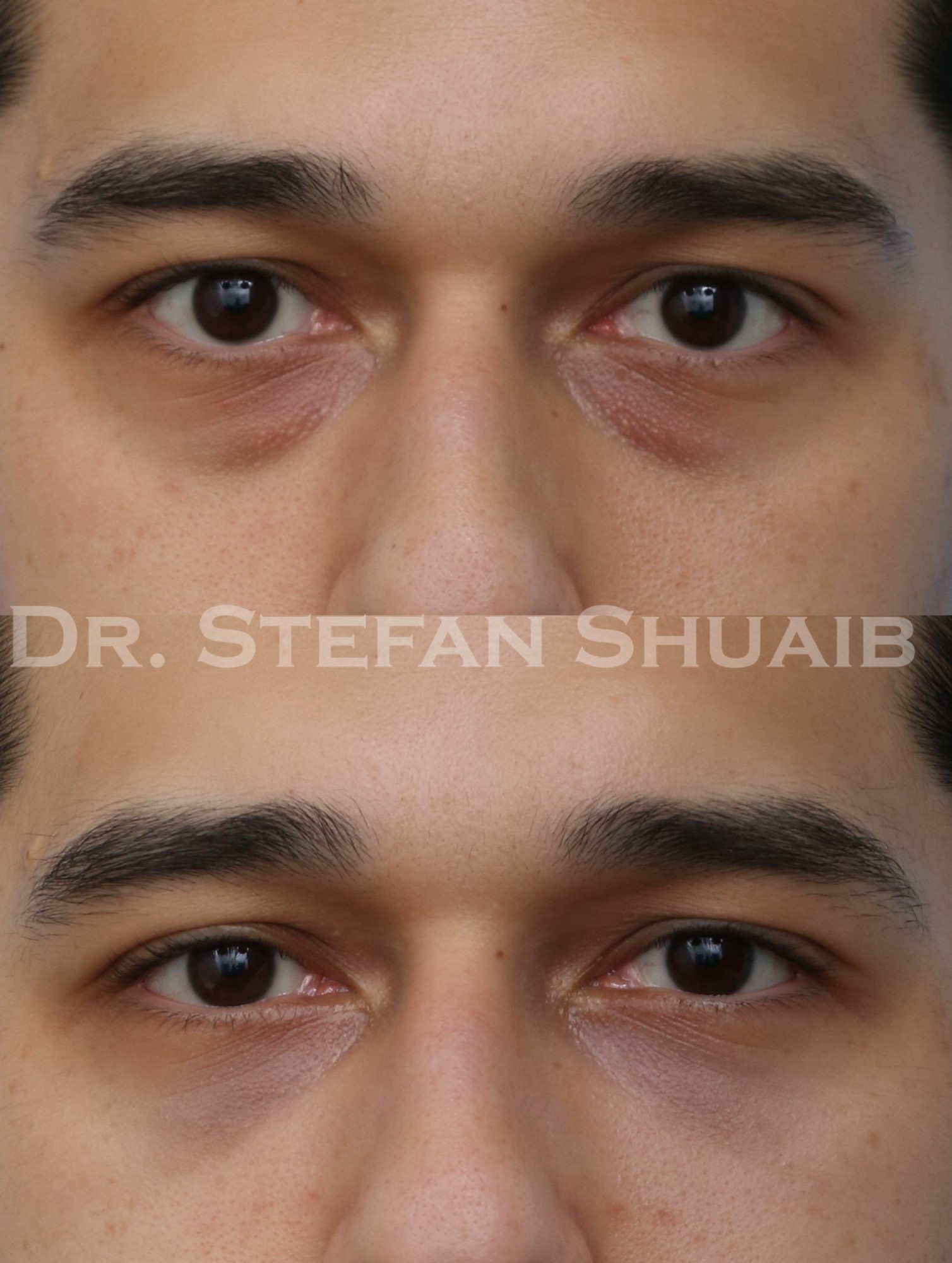 patient before and after blepharoplasty