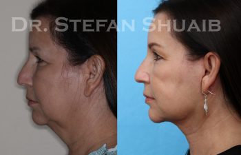 female patient before and after facial rejuvenation