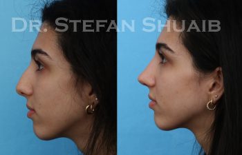 female patient before and after rhinoplasty