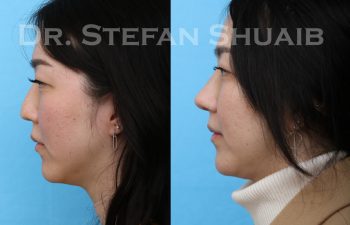 female patient before and after rhinoplasty