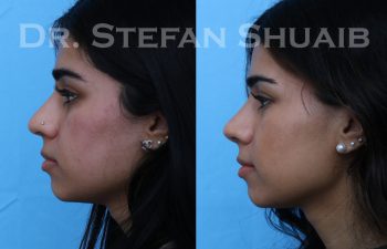 female patient before and after rhinoplasty procedure