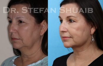 female patient before and after facial rejuvenation