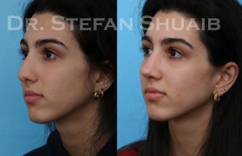 female patient before and after rhinoplasty