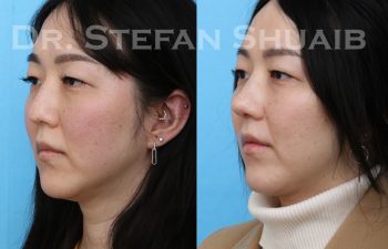 female patient before and after rhinoplasty