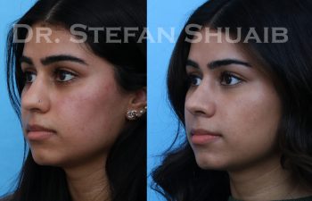 female patient before and after rhinoplasty procedure