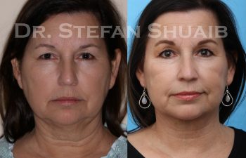 female patient before and after facial rejuvenation