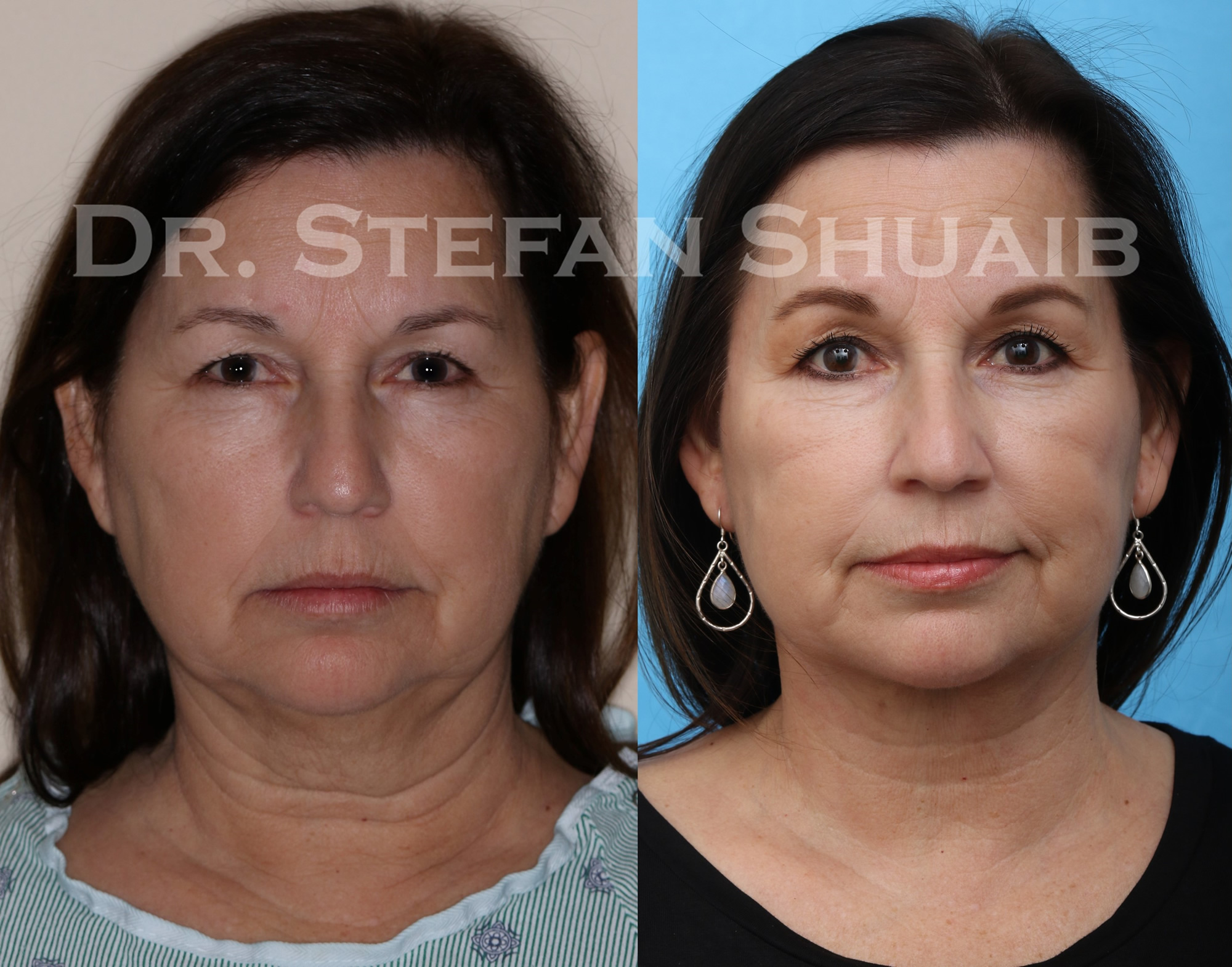 female patient before and after facial rejuvenation